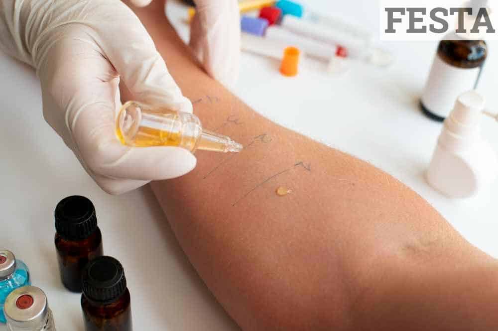 Prueba reacción alérgica